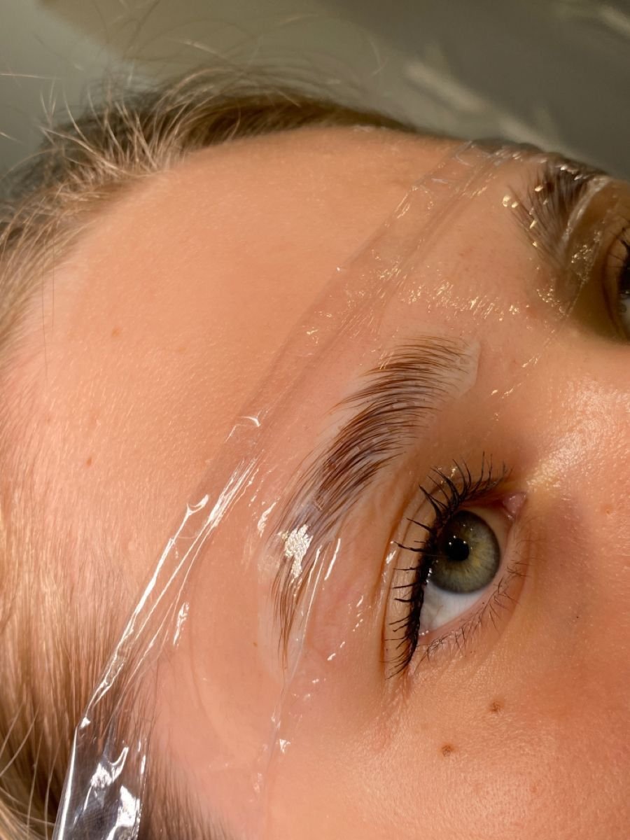 form brow lift